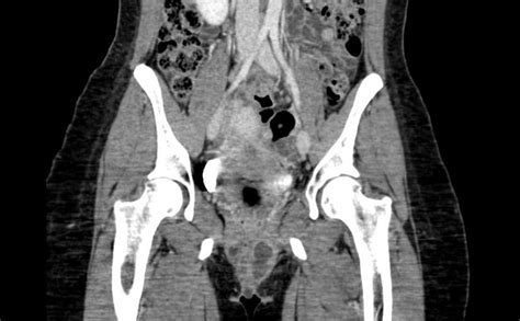 Bartholin's cyst - wikidoc