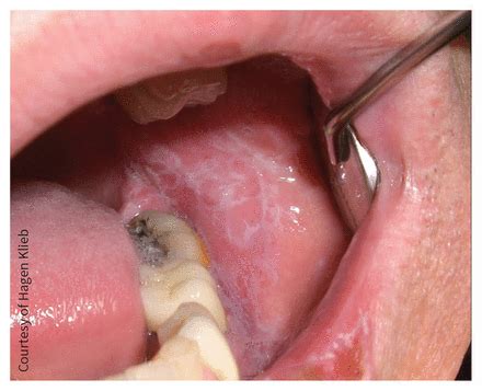 Oral lichen planus | CMAJ