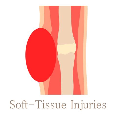 What Is a Soft Tissue Injury?