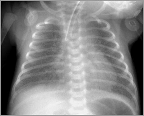 5 NB Lung Diseases-2012