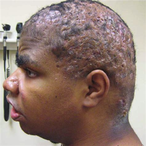 ( a ) Sinus tract at 2x. ( b ) Hyperkeratosis and perifollicular... | Download Scientific Diagram