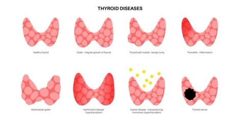 Diet Recommendations for Thyroid Disorders - TCI Hospital EN