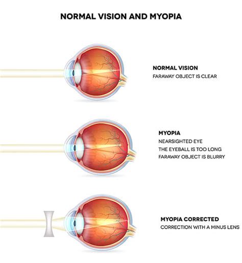 Vision Correction San Antonio | South Texas Eye Institute