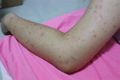 Close-up of the Skin on the Arm of Women with Skin Diseases, Allergies, Rash, Redness, Itching ...