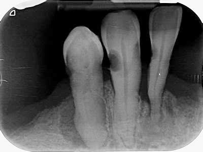 Caries Radiography