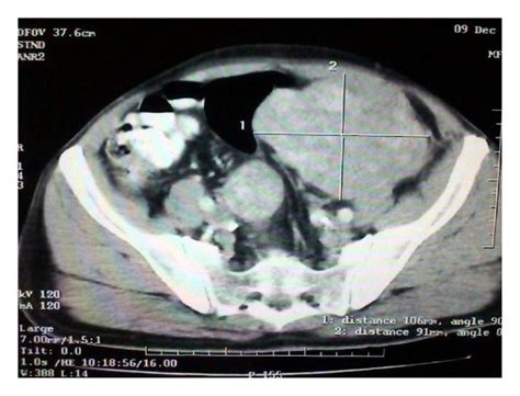 CT scan depicting the left and right iliac fossa mass of the patient ...