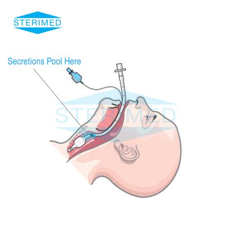 Tracheostomy Tube Suctioning