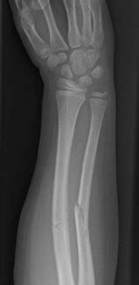 Greenstick Fracture Treatment | Greenstick Fracture Surgery