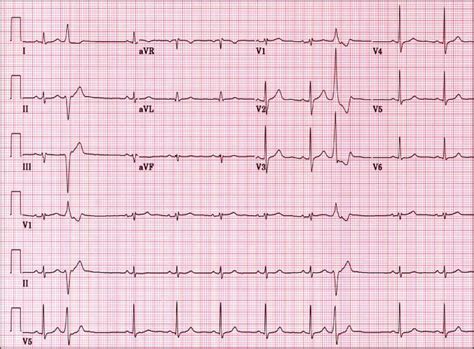 EKG | Diabetes & Endocrinology Specialists