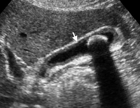 Chronic cholecystitis ultrasound - wikidoc