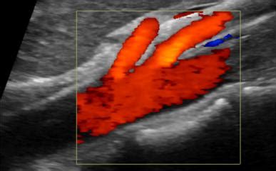 Inferior Mesenteric Artery Ultrasound