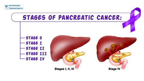 Pancreatic Cancer? - Dr. Kapendra Shekhar Amatya