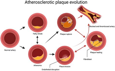 Formation of atherosclerotic plaques and their evolution. The... | Download Scientific Diagram