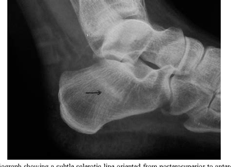 Figure 1 from Bilateral calcaneal stress fractures: a case report. | Semantic Scholar