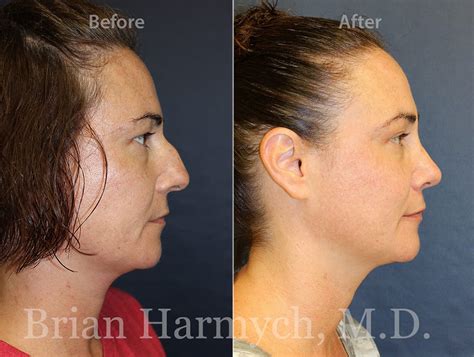 Recovery from Rhinoplasty Surgery