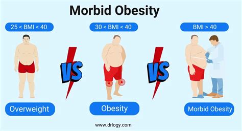 Morbid Obesity BMI Chart: Am I Morbidly Obese? Jet Medical, 48% OFF