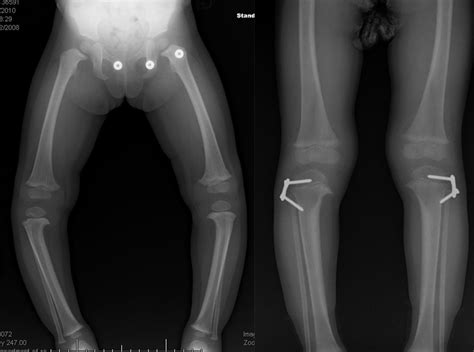 Infantile Blount's Disease - Paley Orthopedic & Spine Institute