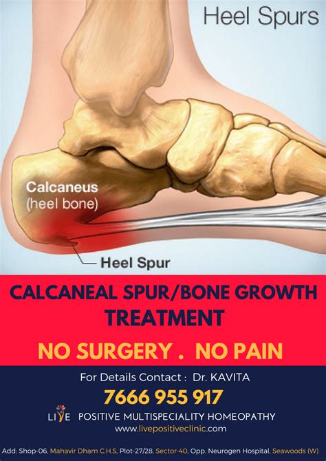 Calcaneal Spur Treatment in Homeopathy [No Surgery] | Live Positive | Multispeciality Homeopathy