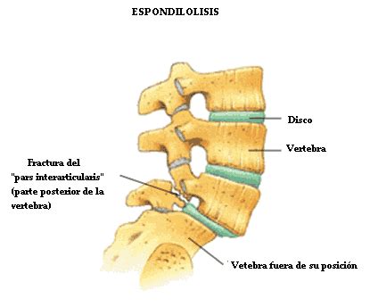 Espondilolisis - EcuRed