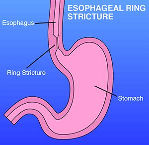 Esophageal Ring Stricture | Gastroenterology & Hepatology of CNY