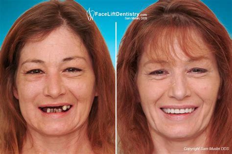 Full Mouth Restoration | Face Lift Dentistry Method