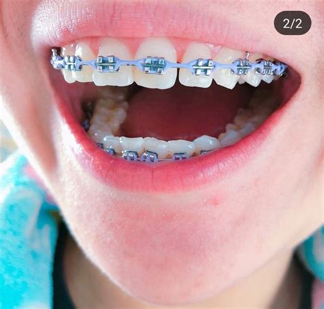 Incredible What Is The Best Color For Braces Quiz Ideas