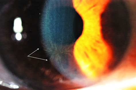 Typical Cornea Verticillata with haze.... | Download Scientific Diagram