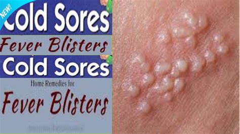 fever blister medicine-Best cold sore treatment ~ Health Physician