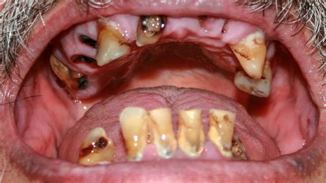 3 Year Old With Rotten Front Teeth - TeethWalls