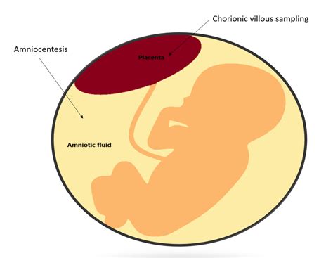 Invasive prenatal diagnosis: Chorionic villous sampling and amniocentesis - HKOG-INFO