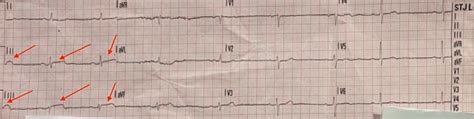 Coronary Vasospasm Presenting as ST-Elevation Myocardial Infarction ...