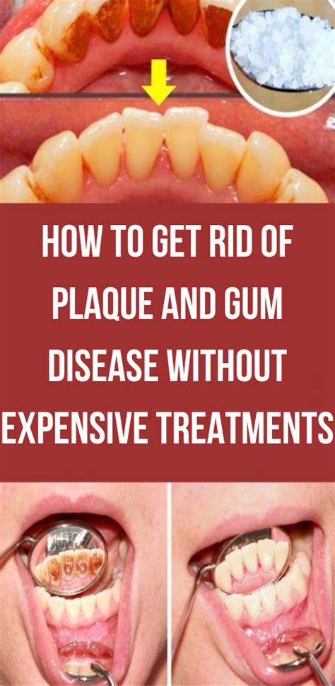 How To Get Rid Of Plaque and Gum Disease Without Expensive Treatments ...