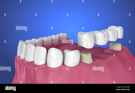 Tooth supported fixed bridge, implant and crown. Medically accurate 3D illustration Stock Photo ...