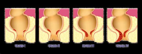 How Do I Know if I Have a Hemorrhoid? - Canadian Digestive Health Foundation