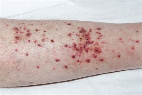 Leukocytoclastic Vasculitis (Allergic vasculitis; Cutaneous small ...