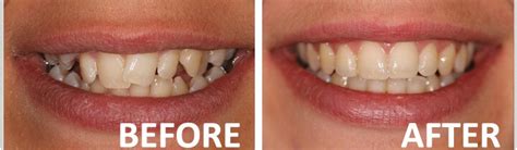 Crooked Bottom Teeth After Braces