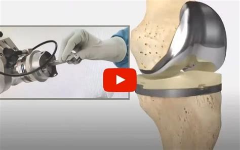 Robotic Knee Replacement: Everything you need to know - Northeast ...