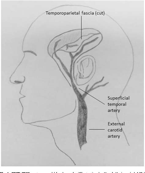 The temporoparietal fascia flap for coverage of cochlear reimplantation following extrusion ...