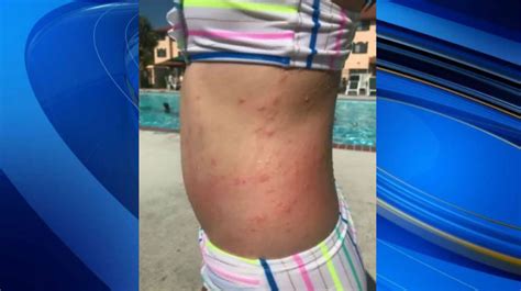 Mom believes sea lice from NC beach caused irritating rash