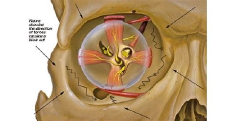 Blow out Fracture - www.medicoapps.org