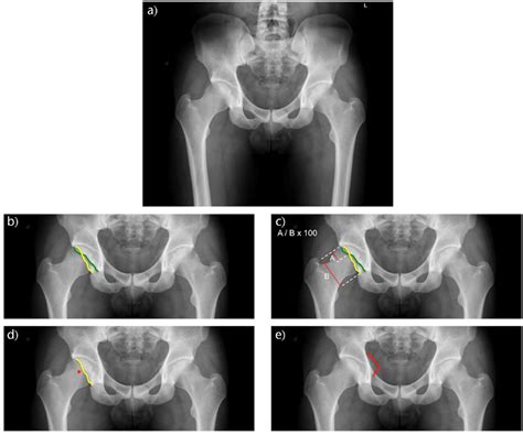 Acetabular retroversion: Diagnosis and treatment in: EFORT Open Reviews ...