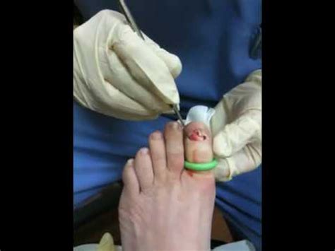 Performing a Total Nail Avulsion - YouTube