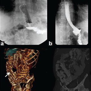 Case of Collis Gastroplasty: Radiologic pictures showing leak (a),... | Download Scientific Diagram