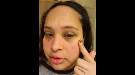 Lupus Butterfly rash covered with Younique makeup - YouTube