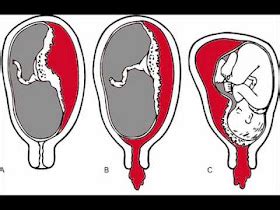 amudu: What is Antepartum Haemorrhage (APH)