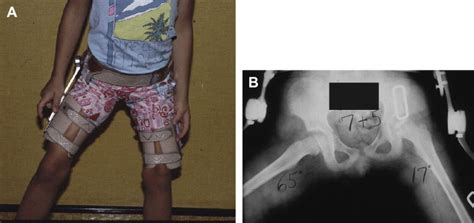 Containment Methods for Treatment of Legg-Calvé-Perthes Disease | Musculoskeletal Key