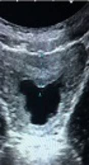 Comparison of Bladder Wall Thickening and Presence of Internal Echoes ...