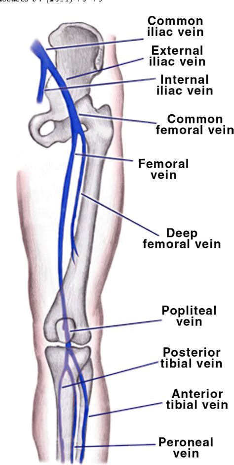 Figure 1 from Endovascular therapies to treat iliofemoral deep venous thrombosis. | Semantic Scholar