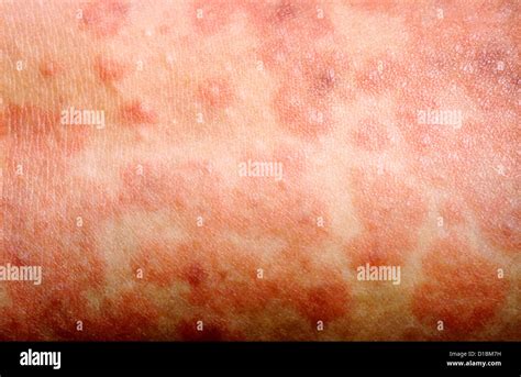 MEASLES RASH Stock Photo - Alamy