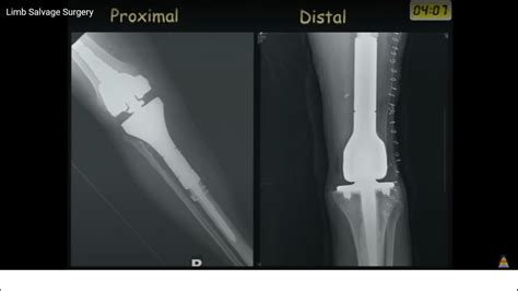 Limb Salvage Surgery: Principles and Current Practice — OrthopaedicPrinciples.com